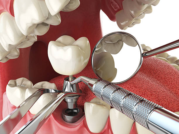 Best Broken or Cracked Tooth Emergency Dentist in Cresson, TX